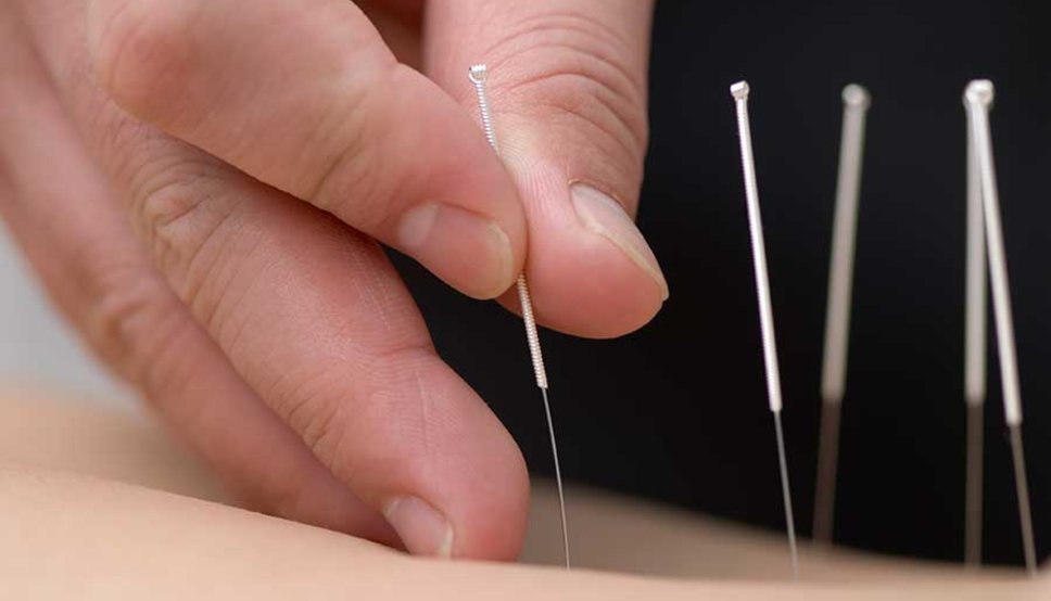 We are pleased and excited to announce that we now offer acupuncture. Acupuncture is a form of alternative medicine and a component of traditional Chinese medicine in which thin needles are inserted into the body to treat various other health problems.